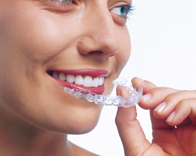 Aligners fit precisely over your teeth