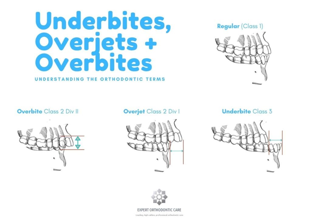 Understanding overbites and underbites