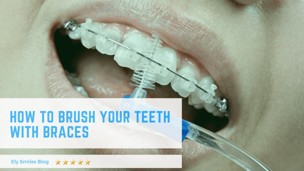 how to brush your teeth with braces
