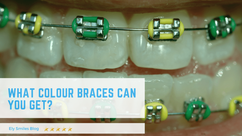 What Colour Braces Can You Get
