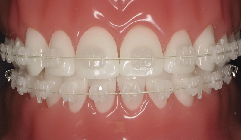 A Comprehensive Guide to How Braces Work: Metal, Invisible, Ceramic, and  Lingual