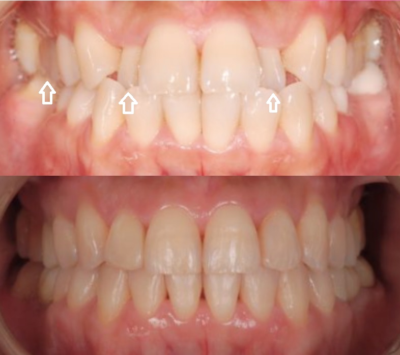 Before and after Invisalign braces