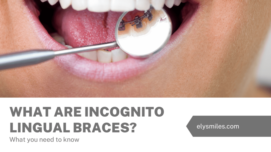 What Are Incognito Lingual Braces?