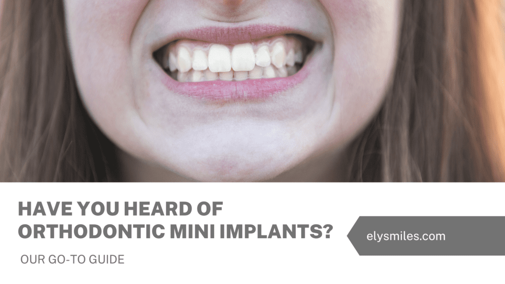 Have You Heard Of Orthodontic Mini Implants? Our Go-To Guide